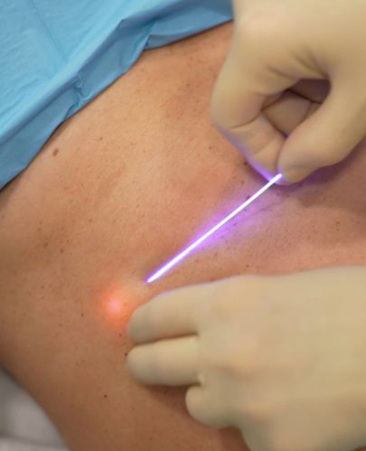 endolifting-corporal-abdomen-clinica-ledesma.jpg “Tratamiento de Endolifting corporal en abdomen realizado en Clínica Ledesma.