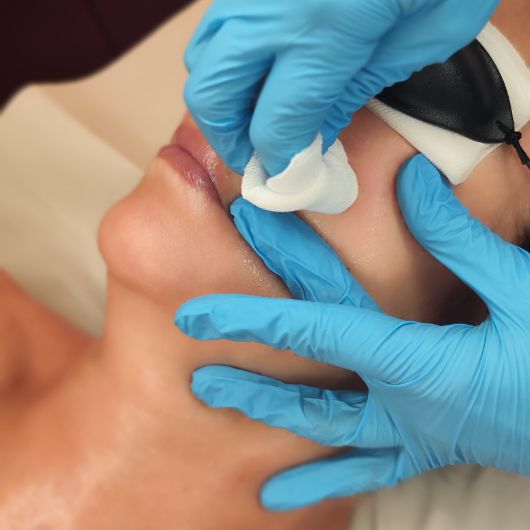 Aplicación de peeling químico profesional facial para renovación cutánea y rejuvenecimiento de la piel en Clínica Ledesma San Vicente del Raspeig.