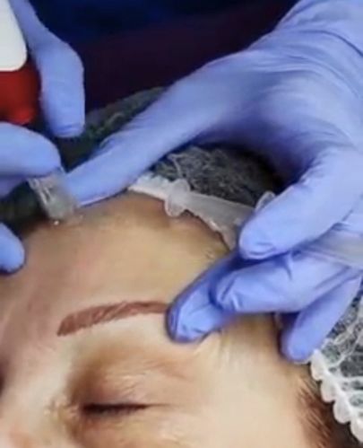 tratamiento-dermapen-facial-clinica-ledesma.jpg