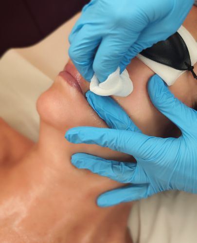 tratamiento-manchas-melasma-clinica-ledesma.jpg